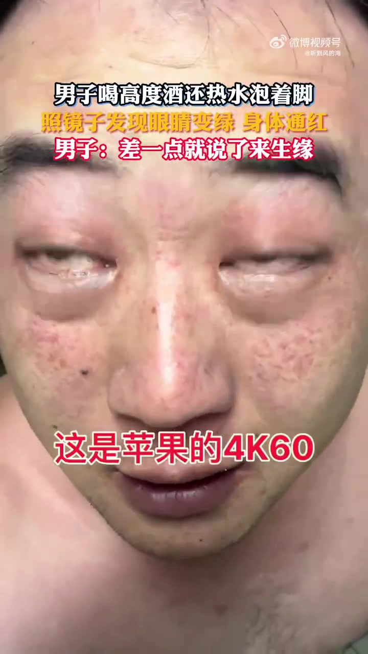 男子喝高度酒还热水泡着脚 照镜子发现眼睛变绿