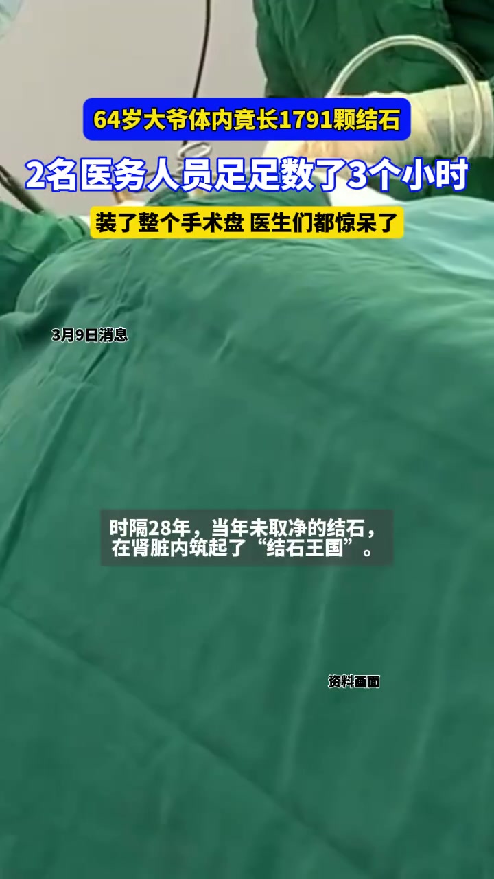 64岁大爷体内竟长1791颗结石